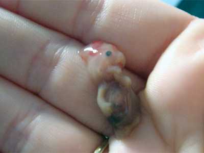 Чтобы исключить это, важно еще на этапе планирования беременности выявить и пролечить любые инфекционные патологии половой сферы