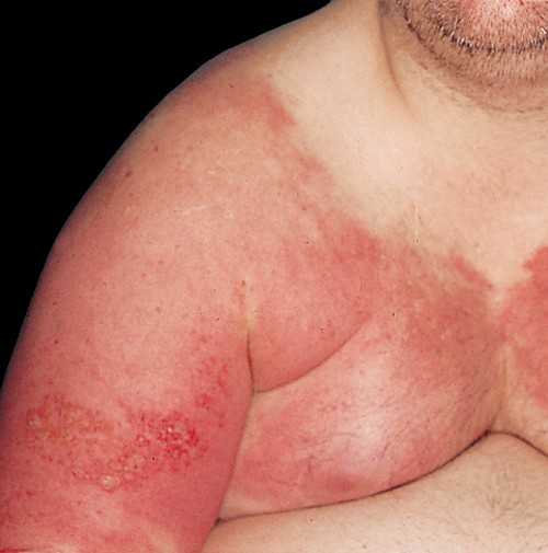 Намного реже воспалительные процессы наблюдаются под волосами