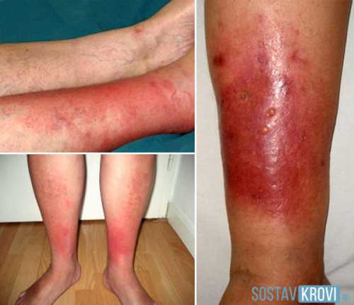 При первой форме развития пораженная рожей область приобретает насыщенный яркокрасный цвет эритема, любое касание к которому достаточно болезненно