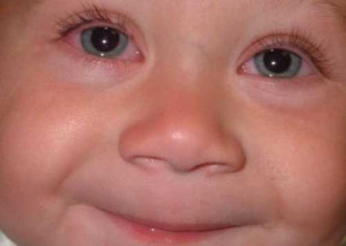 Конъюнктивит у новорождённых: причины, это