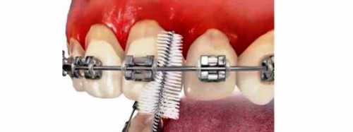 Как чистить брекеты: чем и зачем чистят брекеты,