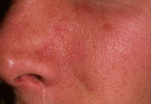 Нарушается чувствительность на пораженных участках вплоть до полного ее отсутствия