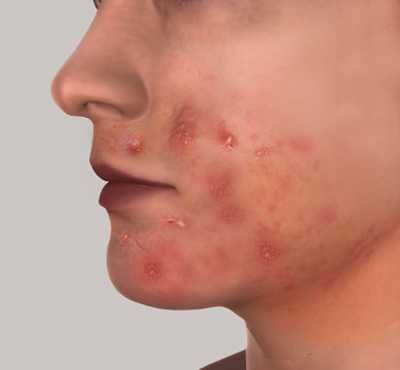 Иногда отмечается отечность, болезненность в зоне воспаления