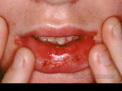 Профилактика стоматита у младенцев