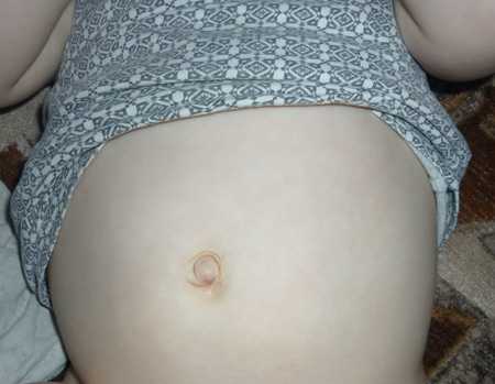 Чаще всего, детская пупочная грыжа не причиняет своему обладателю дискомфорта