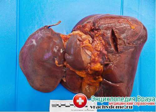 Диета способствует нормальному отделению желчи для пищеварительного процесса