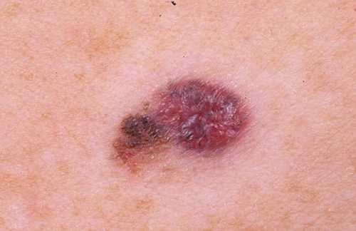 Признаки меланомы