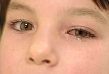 Распространенным средством является раствор альбуцида, который останавливает размножение вредоносных бактерий и способствует очищению от них глазного яблока