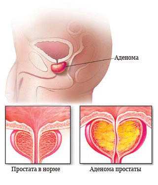 Симптомы и лечение: заболевания простаты