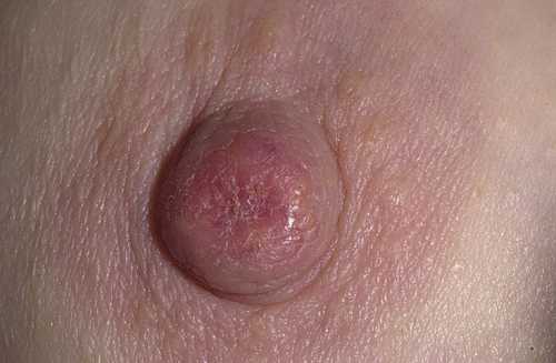 Рак молочной железы