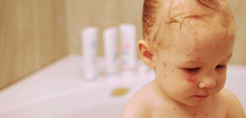 Можно ли купать ребенка при ветрянке