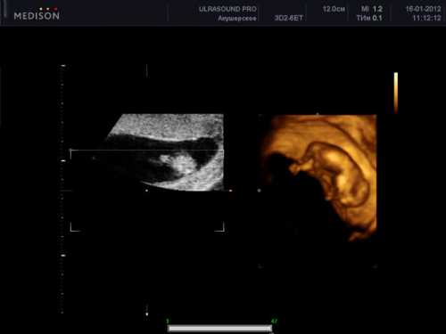 Если беременность вторая и последующая, то живот может уже существенно округлиться