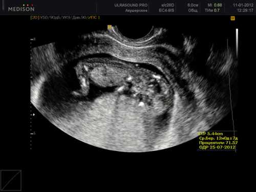 12 недель беременности