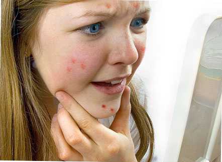 Но самое эффективное средство избавления от постакне это курс салонных пилингов