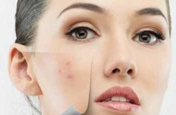 В процессе чистки врач удаляет уже появившийся прыщ, от которого вскоре не остается и следа