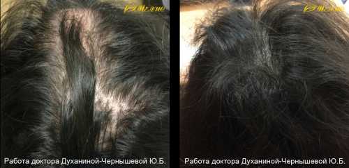 Мезотерапия для волос, волосистой части головы