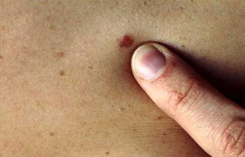 Несомненный плюс петрушки в том, что она не только помогает убрать пигментные пятна на лице, но и делает это бережно, не причиняя вреда и не травмируя нежную кожу, попутно насыщая ее витаминами и минералами