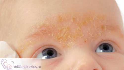 Кремы можно применять для лечения себорейного дерматита на лице, щеках и за ушами