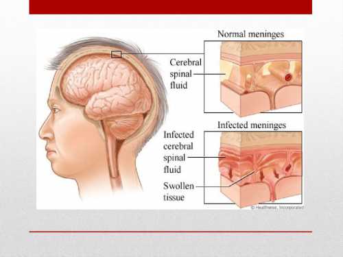 Как распознать клещевой энцефалит: симптомы болезни Как распознать клещевой энцефалит: симптомы болезни
