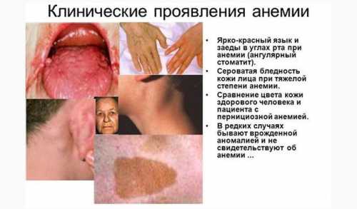 Возникает при недостатке в организме витамина