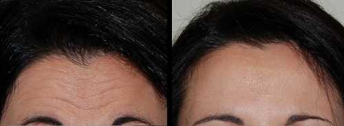 Лучшие советы по устранению морщин на лице