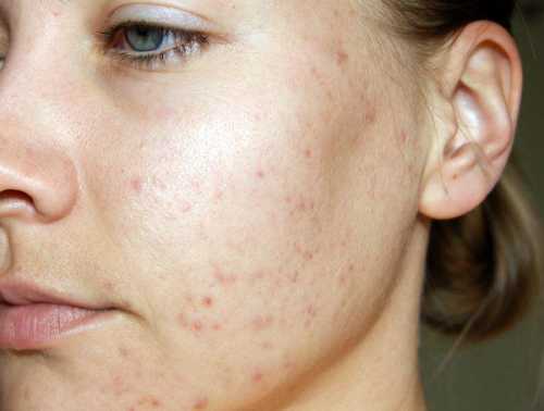 Угри на лице: причины  и что делать
