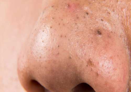 Поверх маски положите махровое полотенце