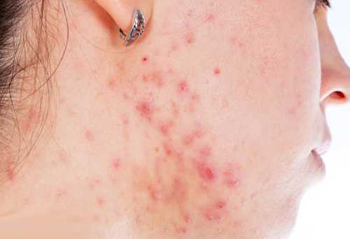 Маленькие прыщики на шее