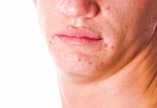 Чаще всего они являются следствием повышенных мужских гормонов или чрезмерного роста волос