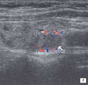 Они также замедляют выработку тиреотропного гормона и чаще всего применяются на ранних стадиях заболевания или перед подготовкой пациента к оперативному вмешательству