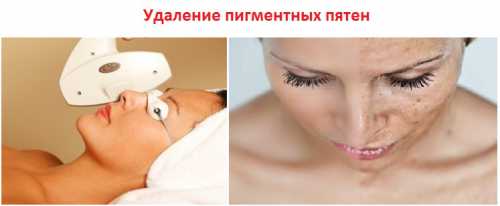 Но если пигментация выражена не слишком ярко или человек не желает обращаться к услугам специалистов, то кожу можно очистить и в домашних условиях