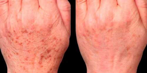 Удаление пятен по правилам