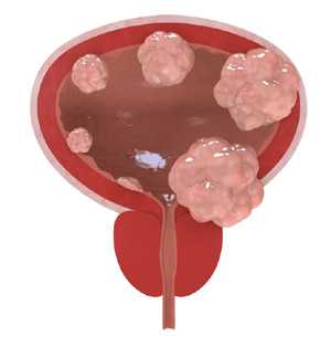 Рак мочевого пузыря у мужчин: симптомы, причины,