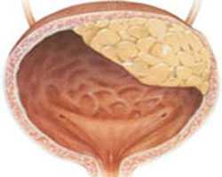 В некоторых случаях, особенно за рубежом, применяется лучевая терапия в дозе
