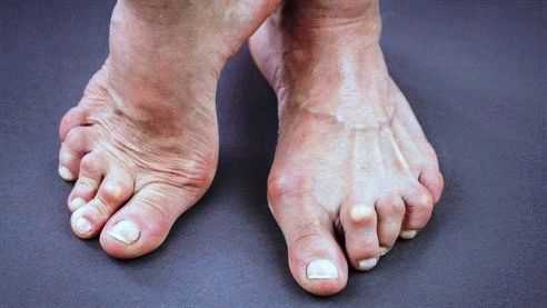 Возможна предшествующая травма нижней конечности