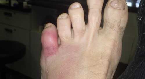 Болит мизинец на ноге