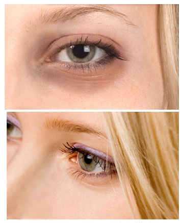 Как убрать морщины под глазами