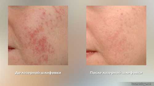 Акне новорождённых: что делать,  что помогает, а