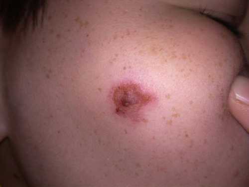 К сожалению дерматологи у нас какието старорежимные в этих вопросах