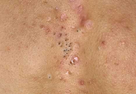 Одна прописала дочке механические чистки и болтушки присыпки всякие сначала лучше стало, а потом такое началось