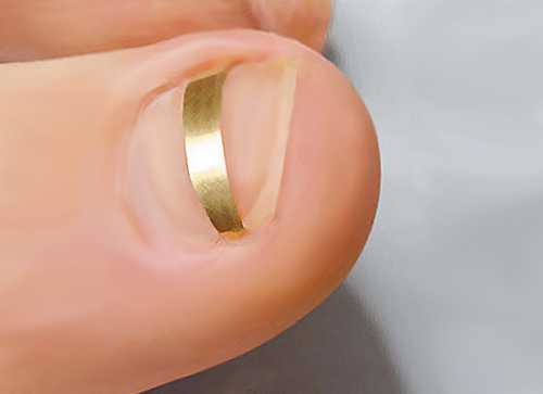 Что делать, если врос ноготь, что поможет и что Что делать, если врос ноготь, что поможет и что