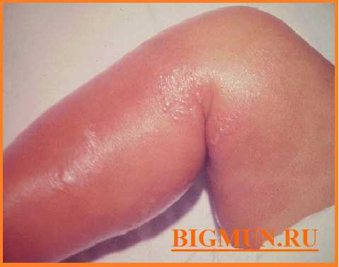 Воспаление голени: симптомы, причины, это